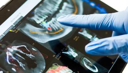 Close-up of a dental X-ray and a hand in a blue surgical glove pointing at one of the details on it. 