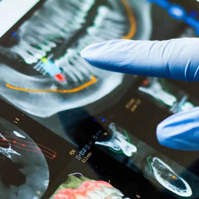 Close-up of a dental X-ray and a hand in a blue surgical glove pointing at one of the details on it. 